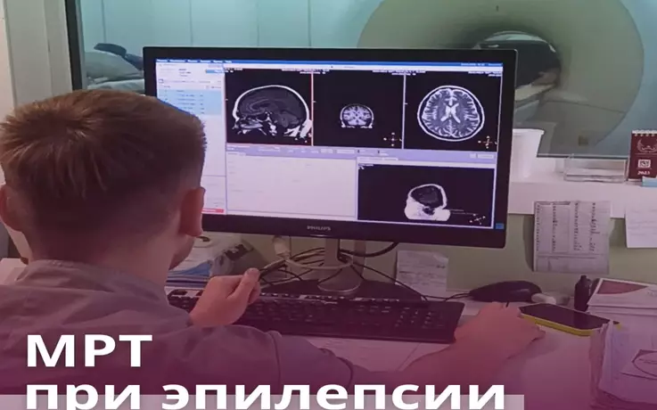 МРТ при эпилепсии
