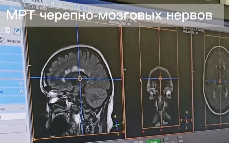 Внимание! Только у нас! МРТ черепно-мозговых нервов