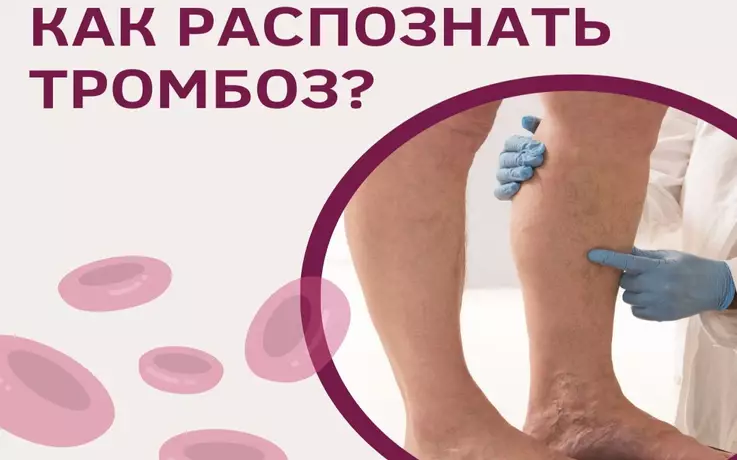 Как распознать тромбоз?